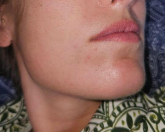 Before and after images tallow for acne