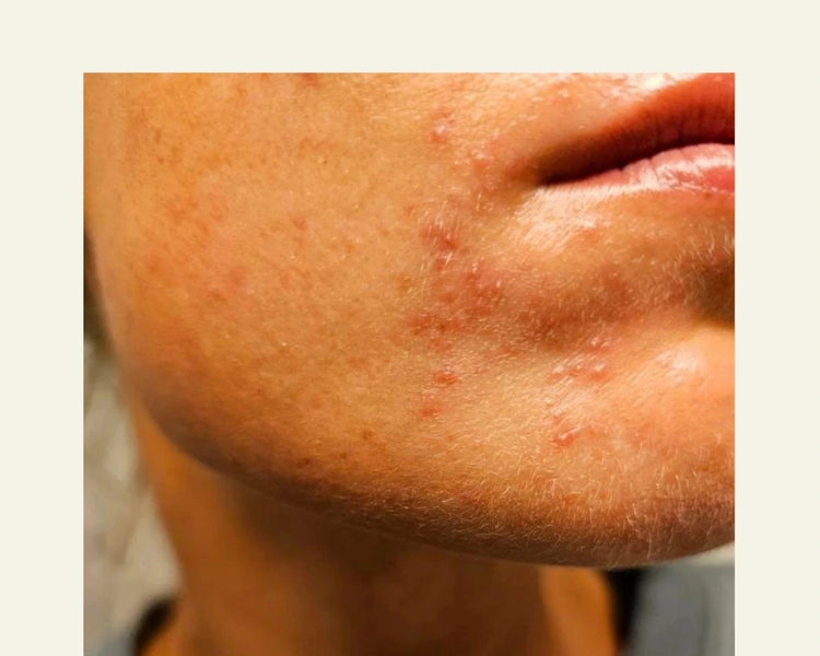 Before and after tallow for acne