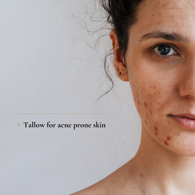 Tallow: De Oplossing voor Acne en Probleemhuid